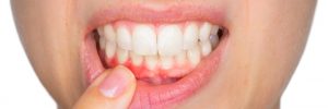 Zahnfleischentzündung durch Zahnbelag (Plaque)